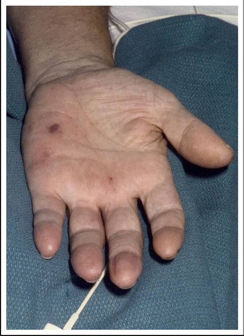 Osler’s Nodes and Janeway Lesions - The American Journal of Medicine