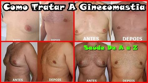Como Diminuir A Ginecomastia - GINECOMASTIA COMO CURAR, Jovem Revela Como Se Livrou Da Ginecomastia ...