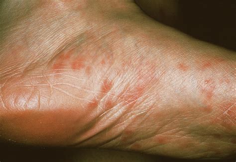 Primary Syphilis