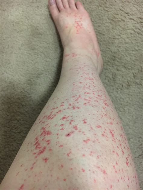 Mystery Rash, had it for a few weeks on my feet, but now it has spread