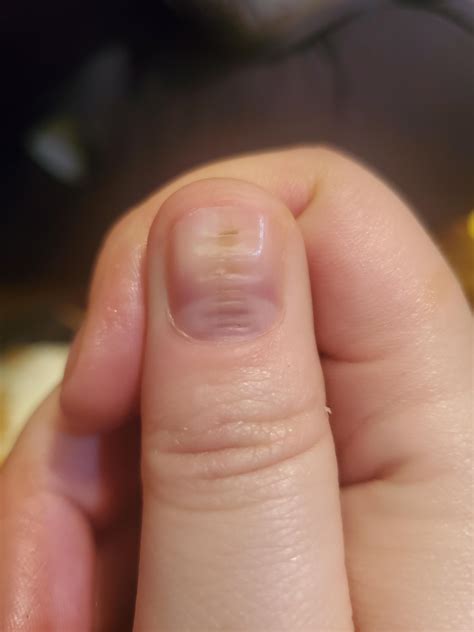 Why do my thumb nails have all these bumps and ridges : r/CanSkincare
