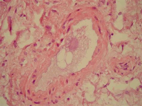 fat embolism syndrome pathophysiology wikidoc