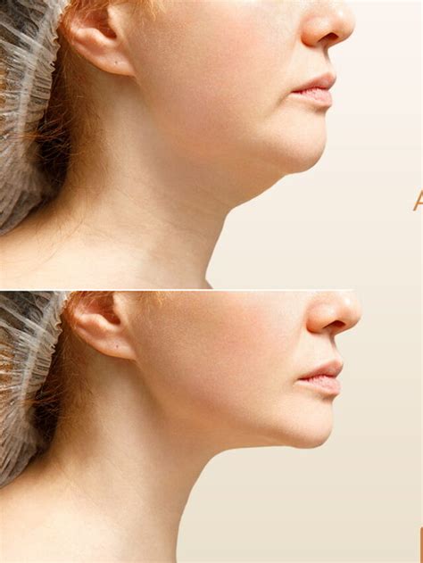 Lipo De Papada Antes E Depois - Lipo de papada: confira o antes e depois deste tratamento - Royal Face