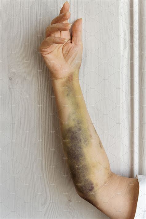 Severe arm bruising after surgery | Health & Medical Stock Photos