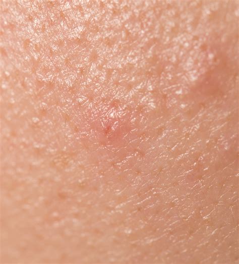 Tinea nigra: Symptome und Behandlung