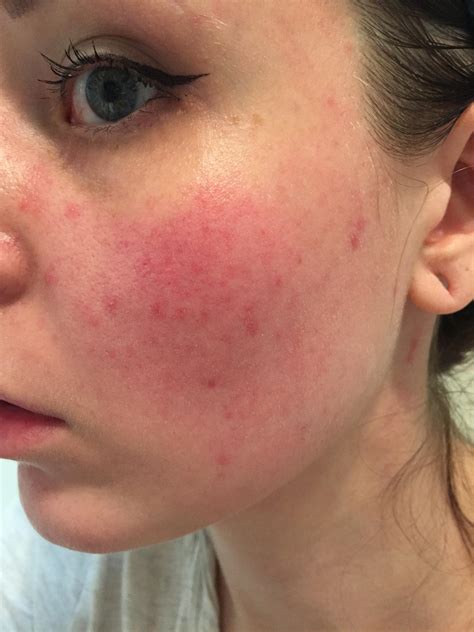 Rosacea Skin Rash On Face