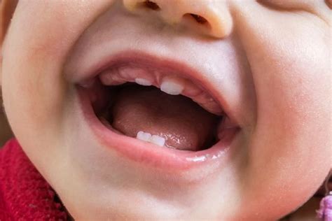 teething  babies symptoms  remedies