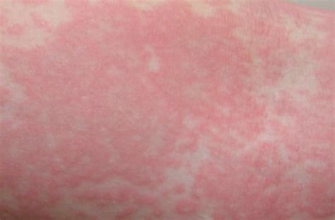 Dr Medico Allergic Reaction Skin Rash Treatment - vrogue.co