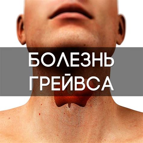 Болезнь Грейвса (диффузный токсический зоб,.. | Медач | Medical Channel ...