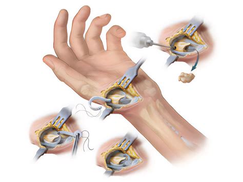 thumb arthroplasty treatment montreal toronto ottawa gatineau