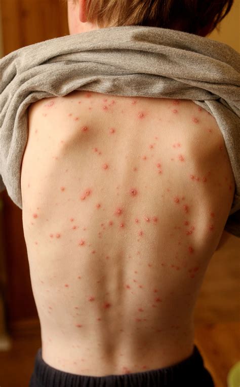 Covid Hands And Feet Rash at Candice Cogar blog