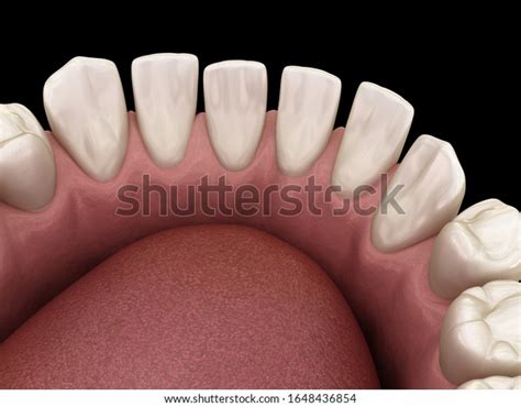 393 Tooth Gaps 3d Images, Stock Photos & Vectors | Shutterstock