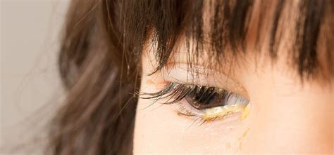 Common Eye Symptoms - Eye Discharge