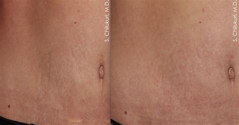 skin tightening refresh dermatology