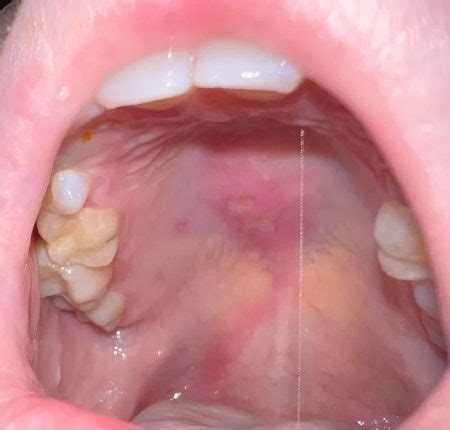 mouth ulcers comprehensive guide   symptoms treatment