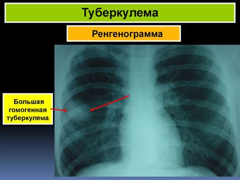 Очаговый туберкулез - презентация онлайн