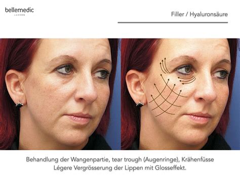 Filler (Hyaluronsäure), Lippenvergrösserung, Faltenbehandlung
