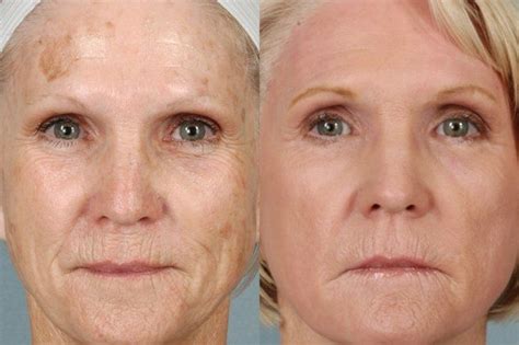 Dr. Suzanne Yee - Little Rock, Arkansas - Laser Resurfacing