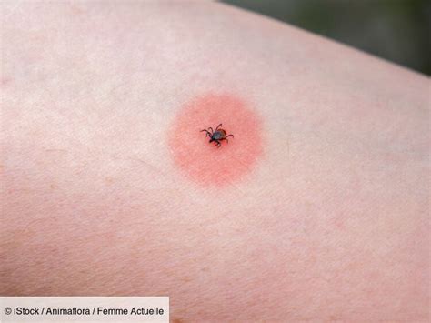 piqure de tique comment savoir  cest une piqure de tique  quand