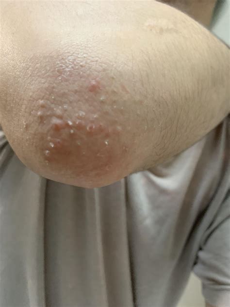 What are these on my elbows? : r/DermatologyQuestions