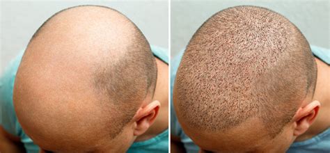 Hair Transplant Recovery And Aftercare | Dr Alam's Advice