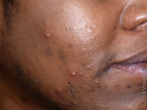 What Does Hormonal Acne Look Like? Images, Signs, and Treatment - GoodRx