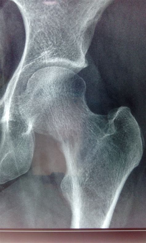 A 25F, presented with severe left hip pain for 2months. Diagnosis and