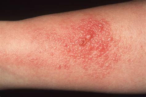 Pictures of 10 Contagious Skin Rashes