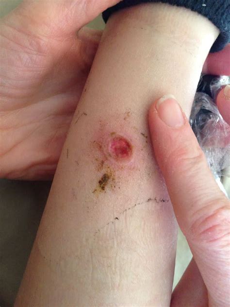 Brown Recluse Spider Bite! - Ridge Haven Homestead