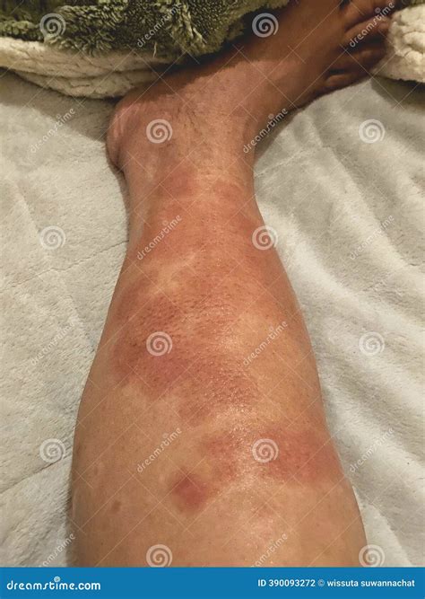 Urticaria Or Hives On The Back, On The Shoulder Red Rashes, Itchy Bumps