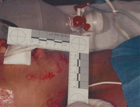 Harrowing pics of my cousin Gabriel Fernandez’s bruised, battered body ...