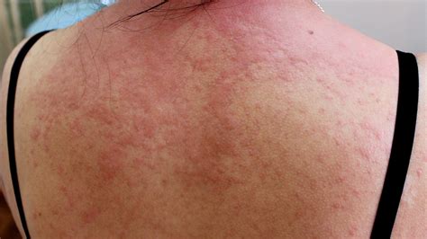 Acute Hives: Causes, Symptoms & Treatment - Hives Treatments