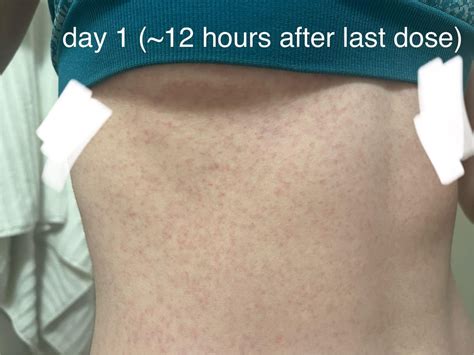 lamictal rash progression pictures : r/lamictal