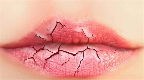 Chapped Lips - Causes, Prevention and Treatment To Get Rid & Cure