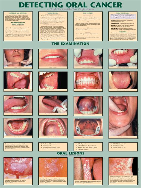 oral cancer poster  cancer head  neck cancer