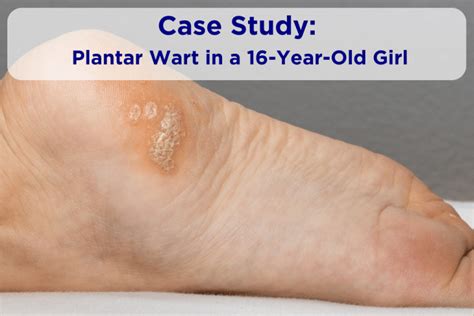 Case Study: Plantar Wart | Leading Edge Podiatry Blackwood