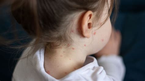 Adult dies in Ireland after contracting measles | World News | Sky News