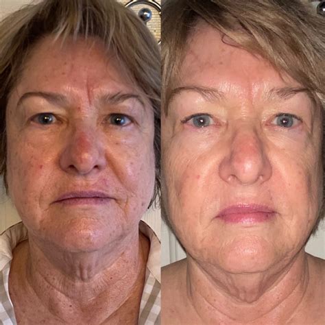 pigmentationuneven skin disorder  reno arosa aesthetics