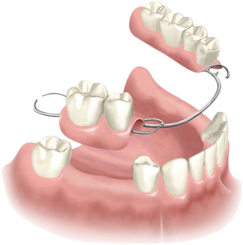 partial dentures windsor ct removable dentures
