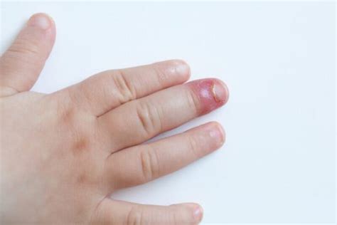 how to cure fingernail fungus fast at home