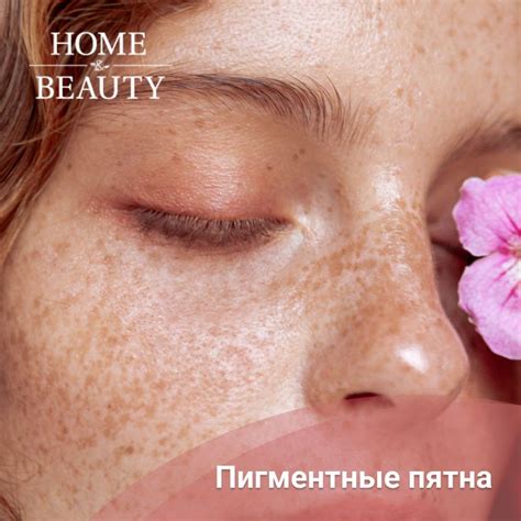 Веснушки - это мило 🥰 Большие пигментные пятна - не очень ☹