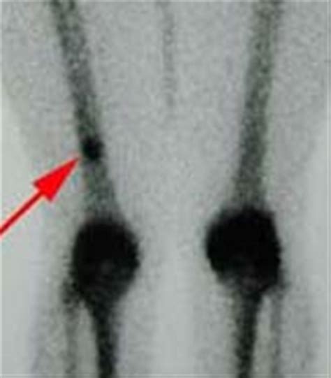 Enchondromas - Pathology - Orthobullets