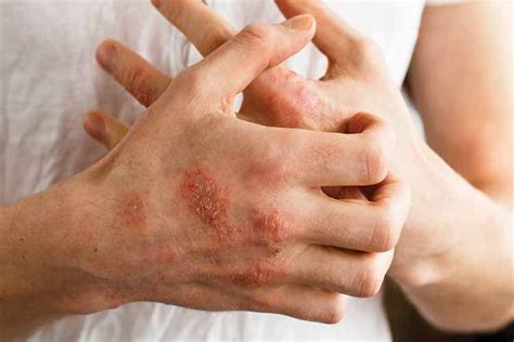 Everything You Need to Know About Eczema