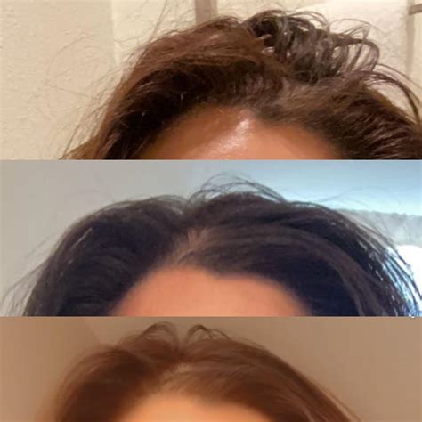 Hair thinning after COVID(?) Please read comment below. : Hair