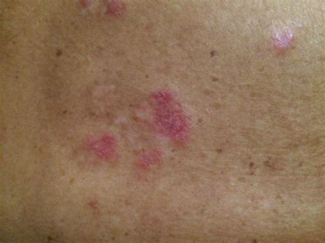 skin reaction doccheck