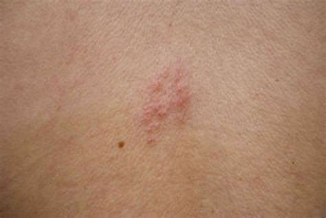 Shingles Pictures: What Does a Shingles Rash Look Like?