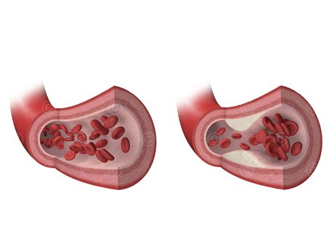 3D Illustration of atherosclerosis - MedicalGraphics