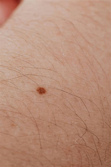 Do moles indicate skin cancer?
