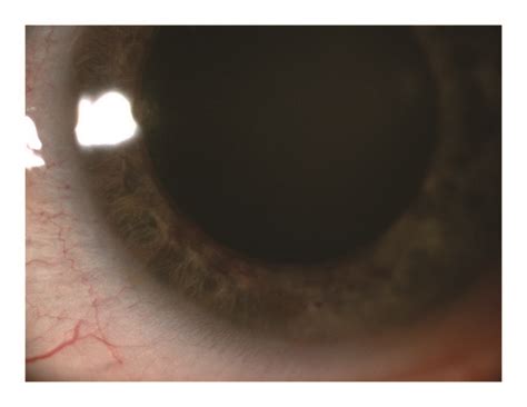 Color anterior segment picture: (a) right eye, whitish cataract and... | Download Scientific Diagram