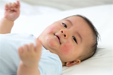 Allergic Reactions In Children